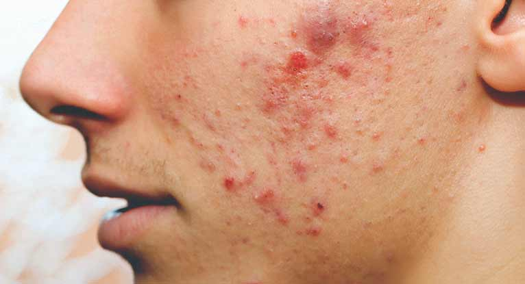 Causes of pimples