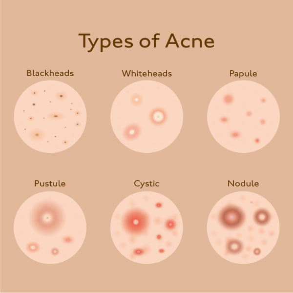 Types of Acne