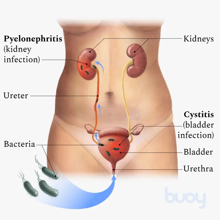 The Infected Kidney 