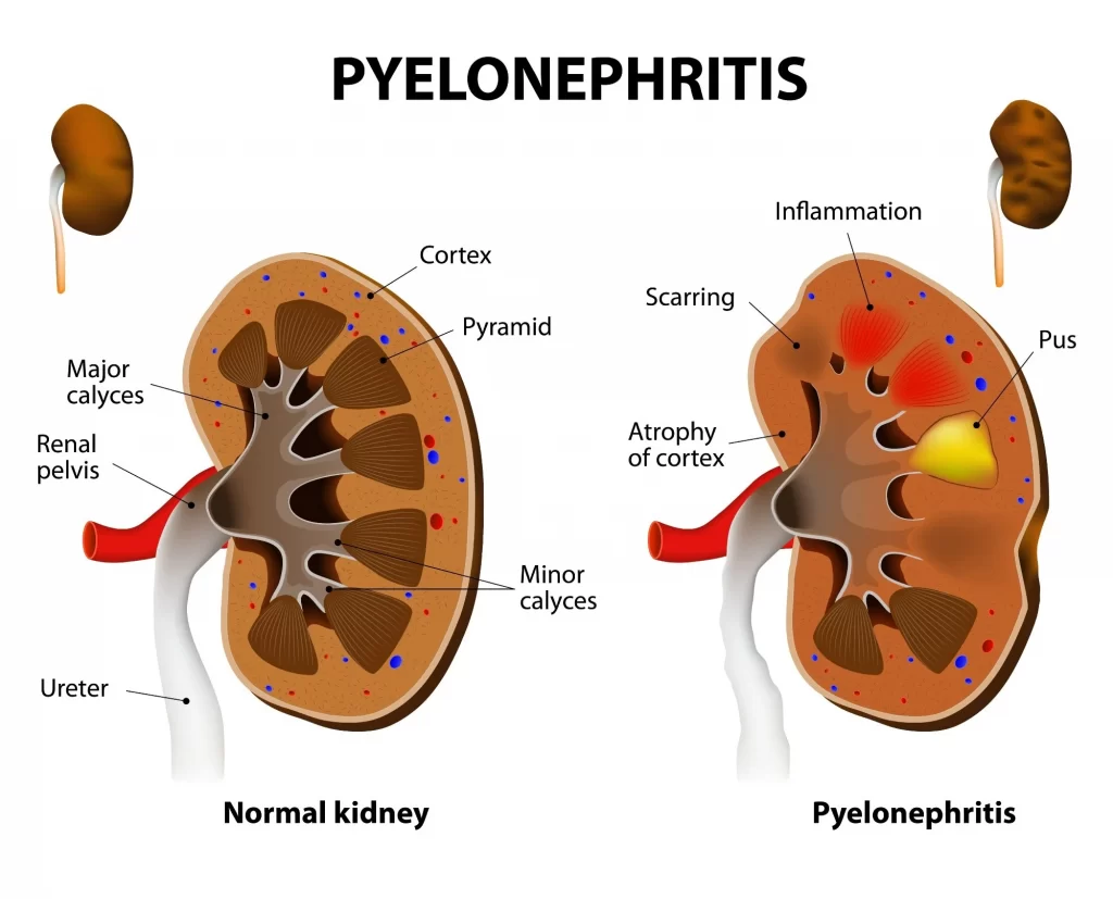 Normal and Infected Kidney