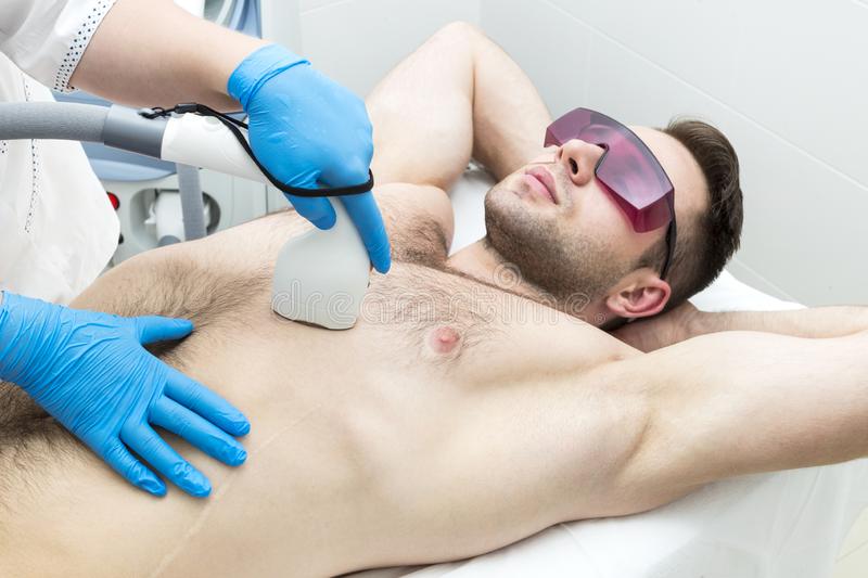 Removing body hair with laser techniques