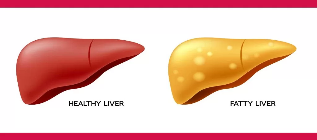 Healthy and the fatty liver