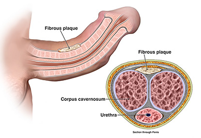the plaque formation in Peyronie's Disease