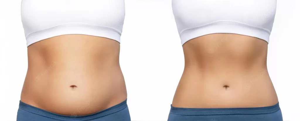 Reduction in belly fat after treatment