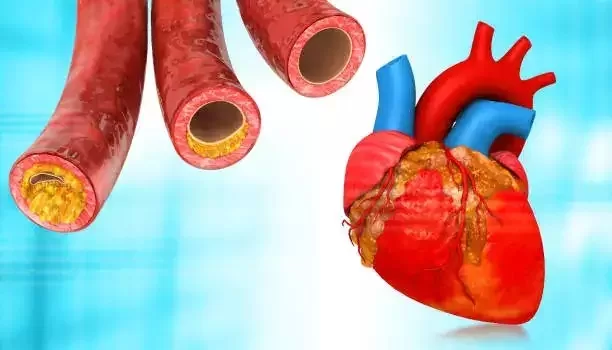 Cholesterol blockage in heart