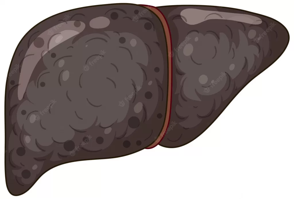  Liver Cirrhosis  and damaged liver