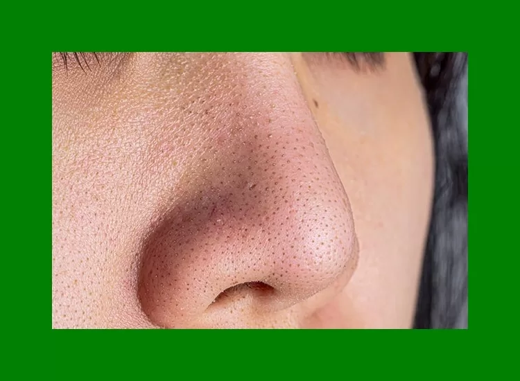 Removal of Blackheads by straming