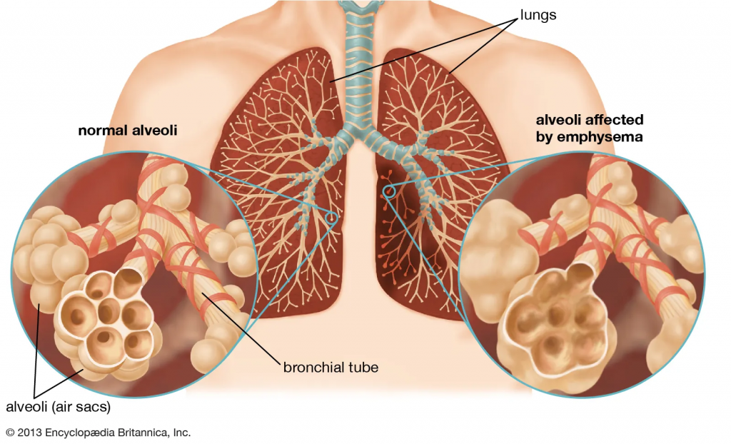 Emphysema and chronic bronchitis 