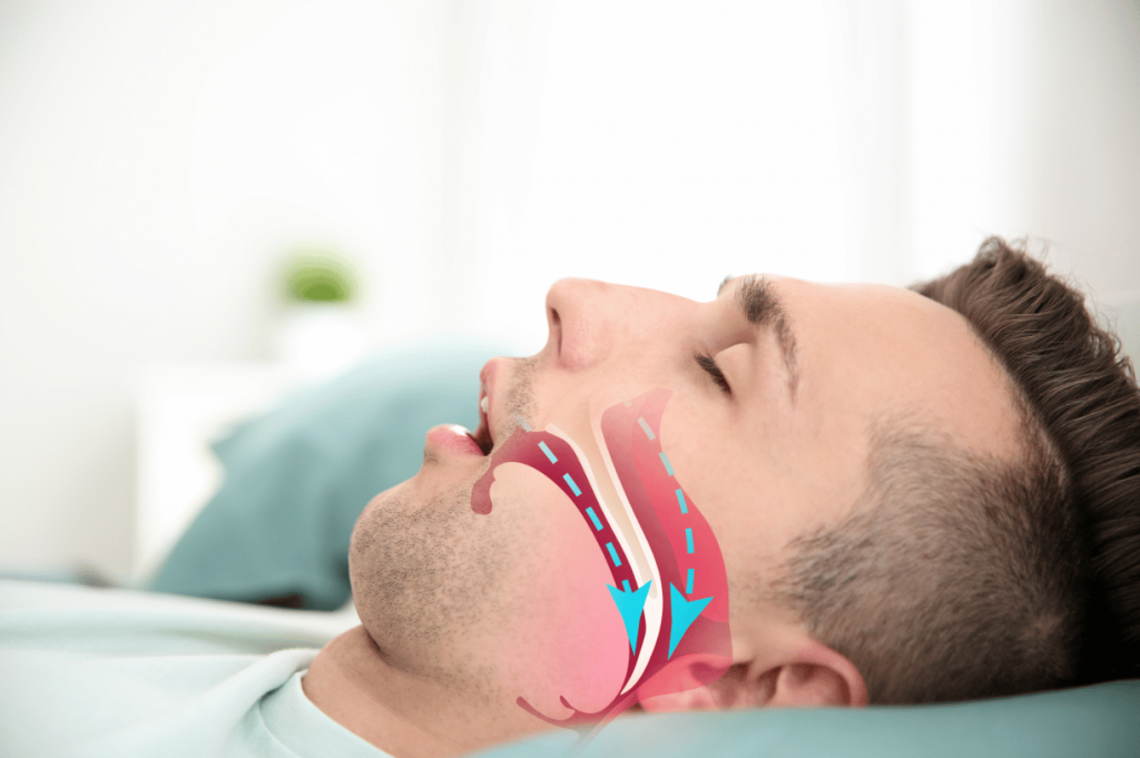 Sleep Apnea symptoms and treatment