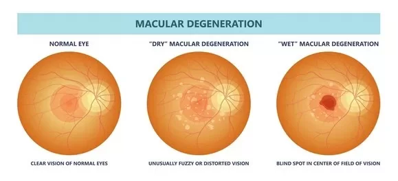 Macular degeneration progression