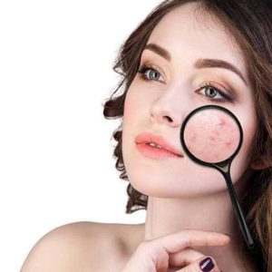 A Complete Guide To Getting Rid Of Pimples Naturally