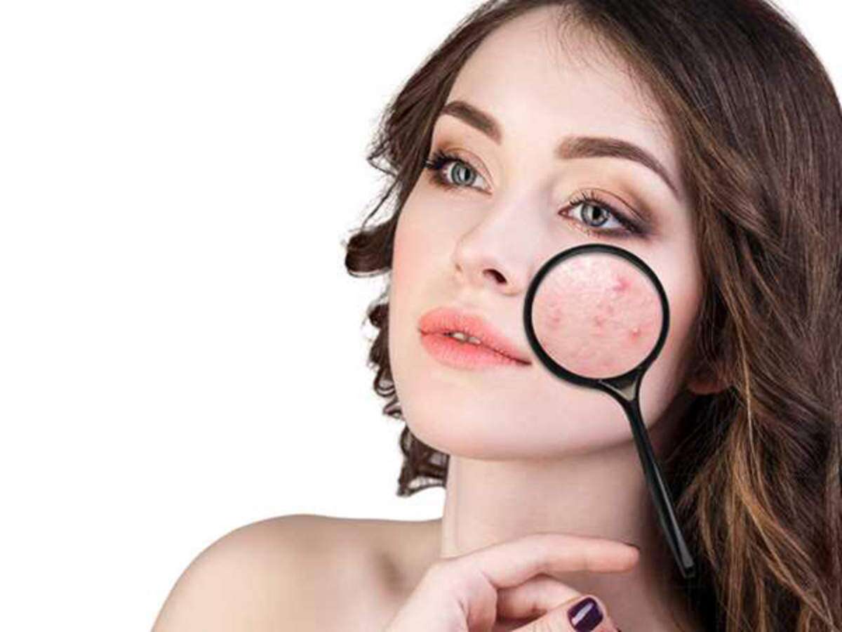 Read more about the article A Complete Guide To Getting Rid Of Pimples Naturally