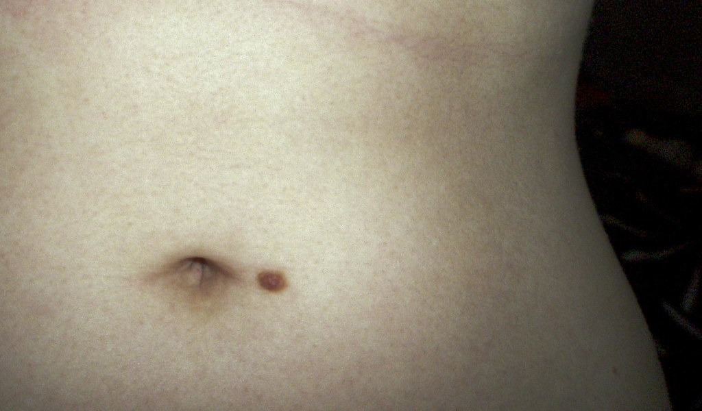 Moles in Stomach