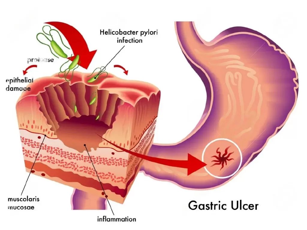 Ulcers in Crohn's patients