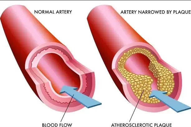 atherosclerosis and artery clogging