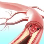 Atherosclerosis-Its Natural Remedies And Prevention Through Herbs And Supplements