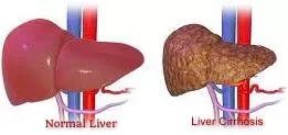 Normal and cirrhosis liver
