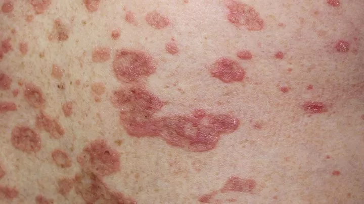 lupus on skin