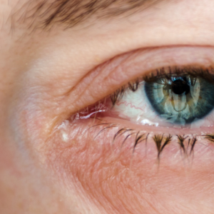 What Is Age-Related Macular Degeneration, Its Consequences And Treatment