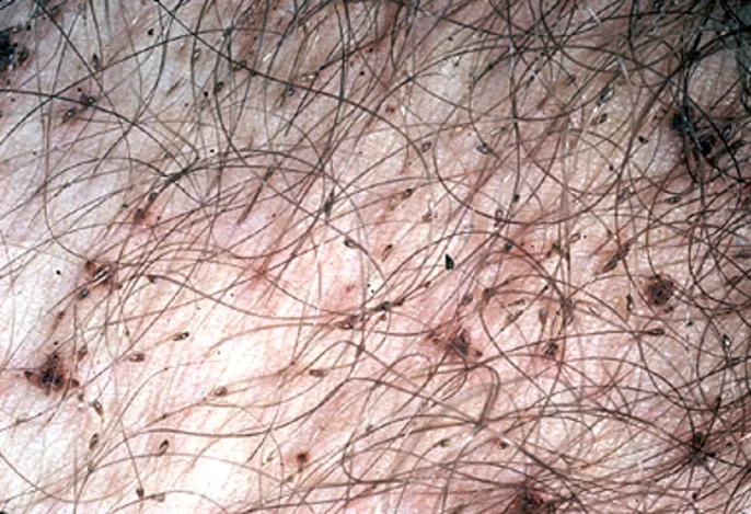 Pubic lice in mens pubic hair around penis