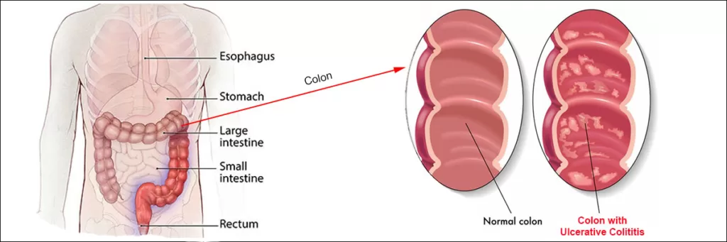 Ulcerative colitis illustrated