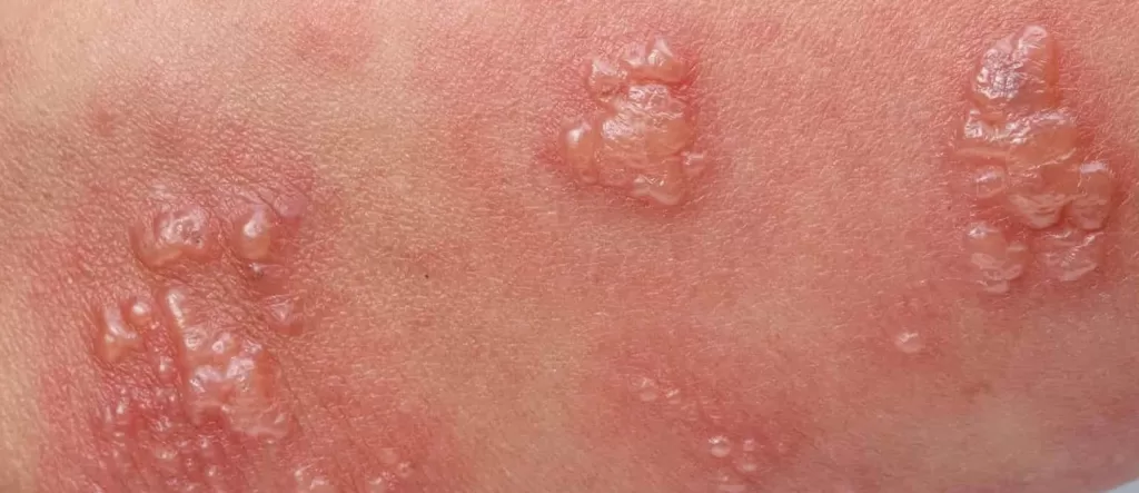 sores on the shaft of penis