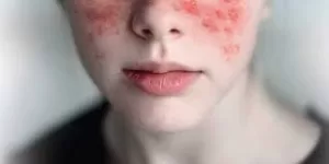 Facial attack of lupus on woman