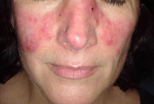 lupus attack on face