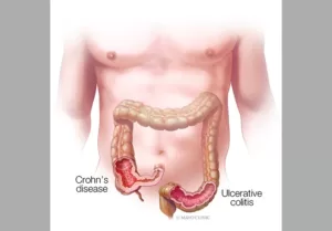 Ulcerative colitis symptoms and treatment