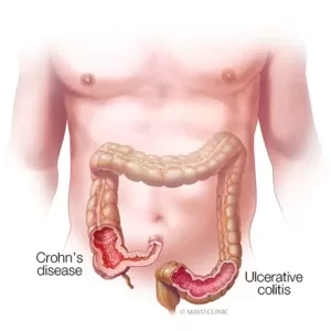 Learn About Ulcerative Colitis And Take Preventive Care Before Its Late