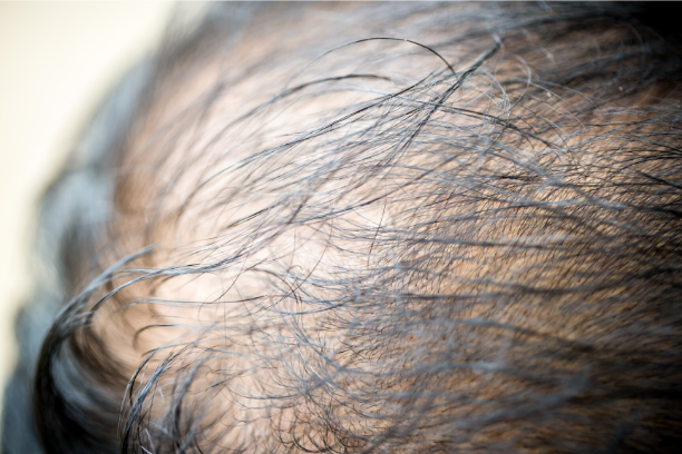 Thinning and hair loss