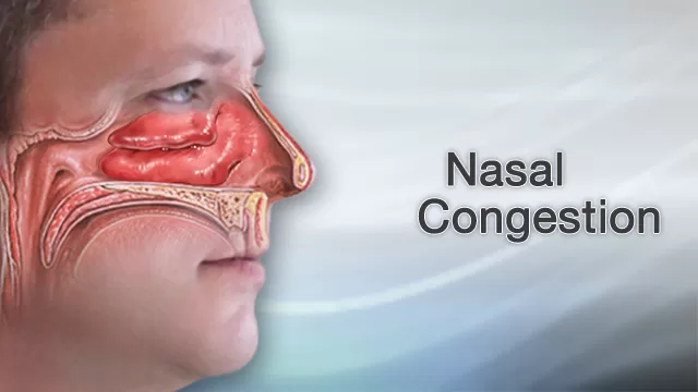 Nasal congestion symptoms