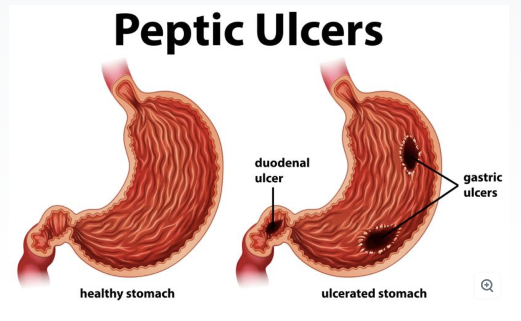 Peptic ulcer image 