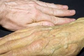 Yellow color  of hands in jaundice