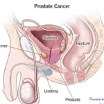 Silent but Deadly: Unmasking the Menace of Prostate Cancer
