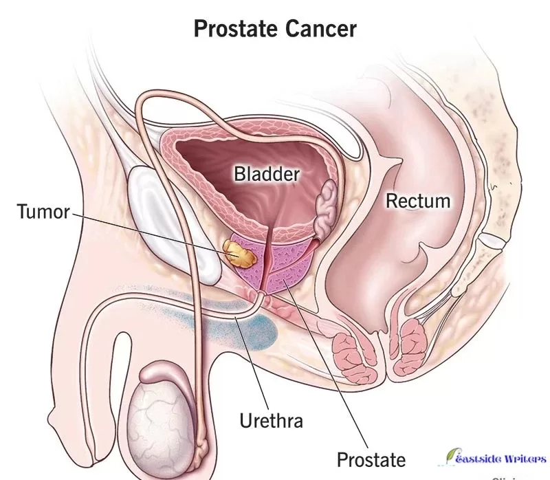 Read more about the article Silent but Deadly: Unmasking the Menace of Prostate Cancer
