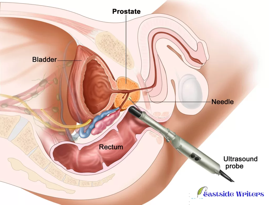 Treatment  of prostate cancer through the Rectum