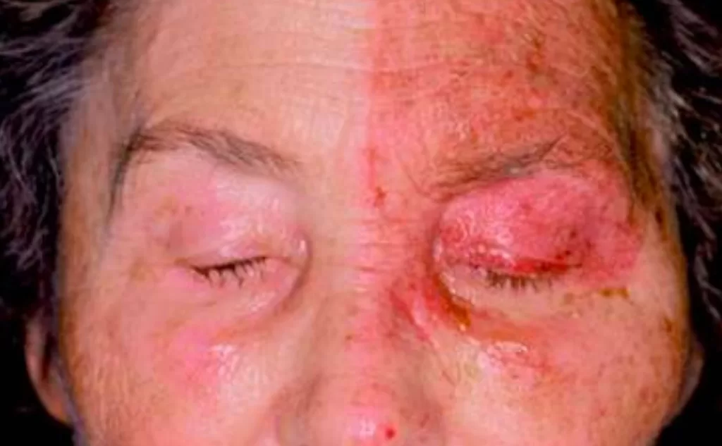 Shingles in the eye area